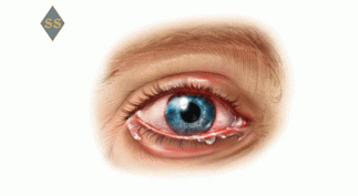 Глаукома – симптомы и профилактика