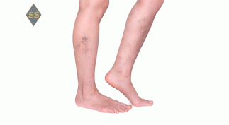 Боль в ногах при варикозе — как избавиться