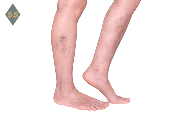Ноги гудят и ноют. Рябь на ногах при гепатите с. Разрастающаяся синюшность на ноге при тромбозе. Варикозное расширение вен нижних конечностей у новорожденных фото.